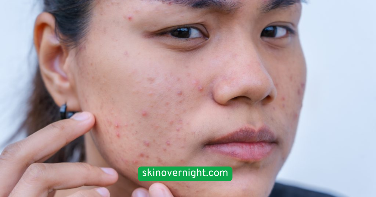  Target Breakouts with Spot Treatments