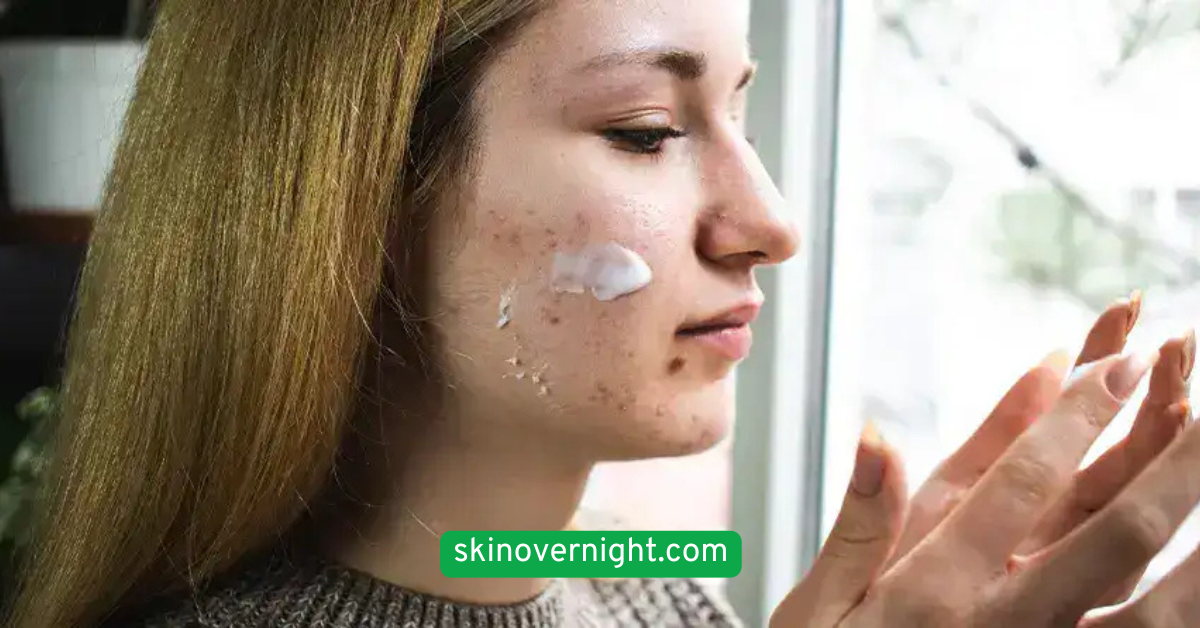 Try Overnight Spot Treatments