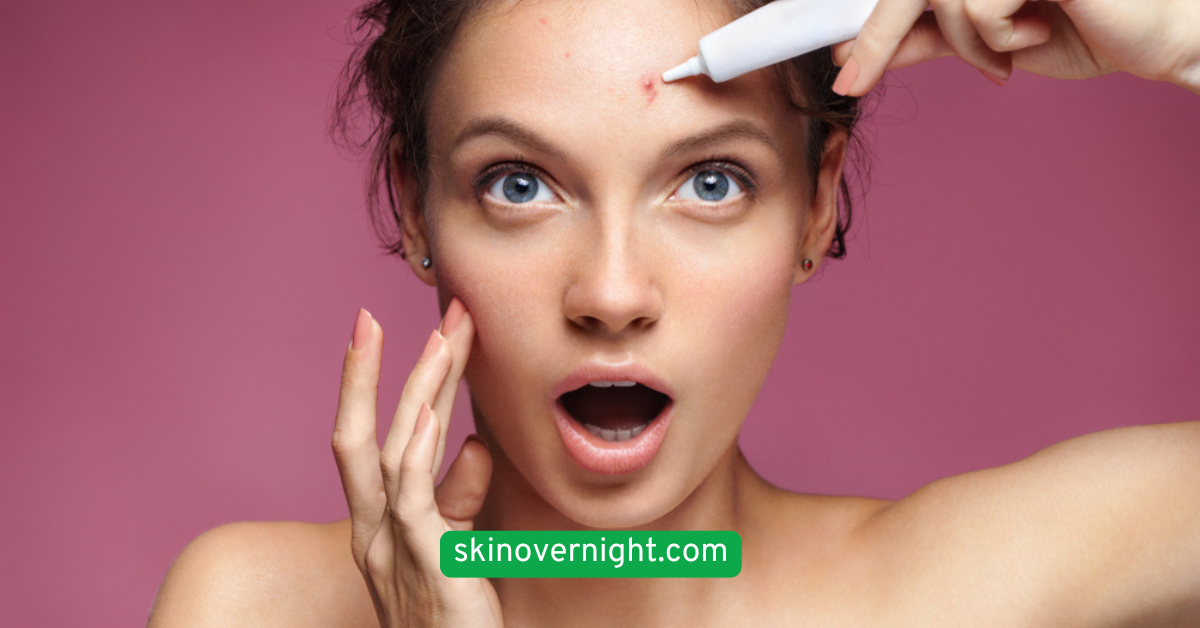 Use a Spot Treatment for Breakouts